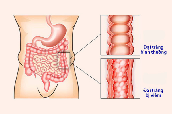 Công dụng của Đại tràng Tâm Bình