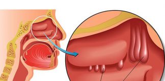 Điều trị viêm mũi xoang mạn có Polyp mũi