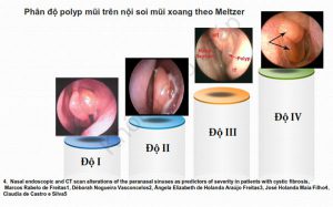Phân độ polyp mũi trên nội soi mũi xoang theo Meltzer