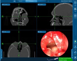 Ứng dụng hệ thống IGS trong phẫu thuật bệnh lí xoang trán tái phát
