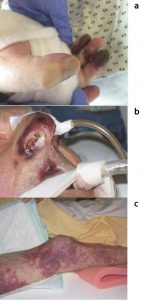 Hình 1.9 Hoại tử đầu chi (a), mũi (b) và da (c) là một biến chứng của DIC cấp tính. Được phép của Martin W. Dünser, MD (a) và Walter Hasibeder, MD (b, c).