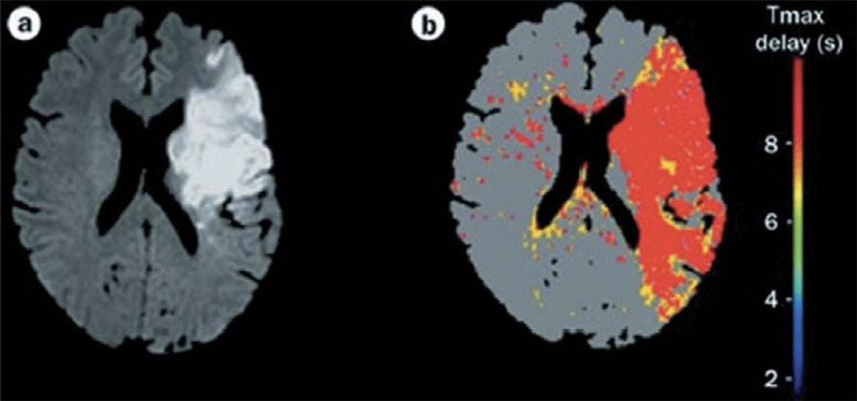 MRI khuếch tán cho thấy một khu vực thay đổi thiếu máu cục bộ (hình ảnh bên trái). Hình ảnh màu bên phải cho thấy các khu vực giảm tưới máu (màu đỏ và vàng). Phép trừ kỹ thuật số của khu vực giảm tưới máu (bên phải) với khu vực thiếu máu cục bộ (ở bên trái) sẽ cho thấy các khu vực bị đe dọa nhồi máu. Hình ảnh từ Tài liệu tham khảo 15.