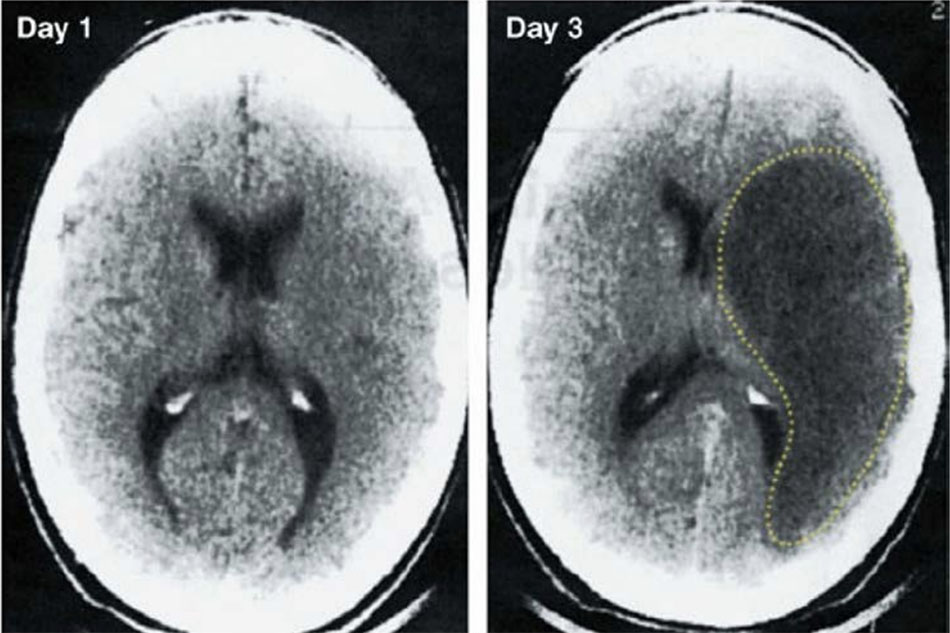 Hình ảnh CT không tương phản từ ngày thứ nhất và ngày thứ ba sau đột quỵ thiếu máu cục bộ. Hình ảnh vào ngày 1 không thể hiện, nhưng hình ảnh vào ngày thứ 3 cho thấy một vùng giảm đậm độ lớn (được vạch ra bởi đường chấm chấm) với hiệu ứng choáng chổ, đại diện cho sự phá hủy mô rộng lớn với phù nề trong não. Hình ảnh từ Tài liệu tham khảo 13.