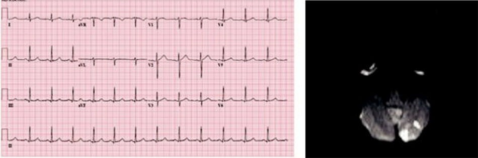 ecg