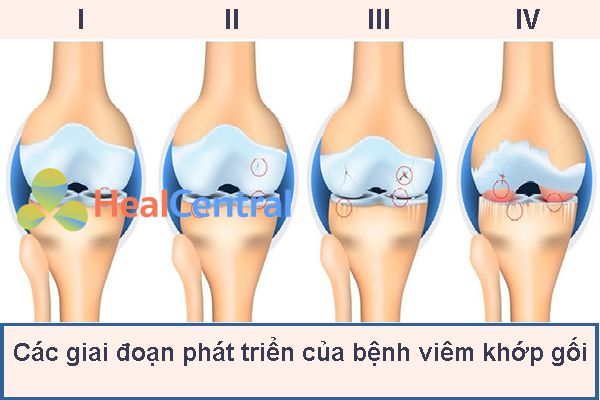 các giai đoạn phát triển của viêm khớp gối