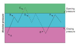 Hình 5.1 Sơ đồ của một phế nang với áp lực phế nang khác nhau. Đường liền nét thể hiện phế nang ở trạng thái đóng và đường chấm đại diện cho phế nang ở trạng thái mở. Lưu ý rằng áp lực phế nang tại Điểm B, Điểm D và Điểm F là như nhau, nhưng phế nang bị đóng tại Điểm B và Điểm F và mở tại Điểm D. Đặt PEEP trên áp lực đóng sẽ ngăn chặn phế nang đang mở đóng lại.