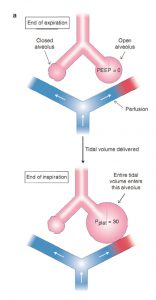 Hình 5.2 Hai mô hình phế nang về tác động tiềm năng của PEEP tăng lên đối với độ giãn nở phế nang và tưới máu phế nang. (a) Không tăng PEEP, phế nang bên phải vẫn mở, trong khi phế nang bên trái vẫn đóng. Giả sử phế nang kín có áp lực mở cao, toàn bộ thể tích khí lưu thông với hít vào sẽ chỉ đi vào phế nang mở, dẫn đến áp lực cuối thì hít vào (bình nguyên ) cao. Các phế nang kín không tham gia trao đổi khí với mao quản. (b) Nếu PEEP tăng duy trì mở phế nang bị sụp, cả hai phế nang vẫn mở khi thở ra. Toàn bộ thể tích khí lưu thông với hít vào sẽ được phân chia giữa hai phế nang, cải thiện độ giãn nở tổng thể của phổi và có thể làm giảm áp lực cuối thì hít vào (bình nguyên ). Cả hai phế nang tham gia trao đổi khí với các mao mạch.
