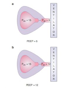 Hình 7.5 Tăng áp lực đường thở gần với PEEP bên ngoài có thể làm giảm công hô hấp cần thiết để kích hoạt máy thở trong bối cảnh PEEP tự động. (a) Ở cuối thì thở ra, áp lực của phế nang cao hơn đáng kể so với áp lực đường thở gần, cho thấy sự hiện diện của PEEP tự động. Giả sử độ chênh lệch là 5 cm H2O giữa áp lực đường thở gần và áp lực phế nang là cần thiết để đạt được áp lực ngưỡng và/hoặc thay đổi lưu lượng để kích hoạt máy thở, bệnh nhân phải giảm áp lực phế nang xuống 0 cm H2O (giảm 15 cm H2O) trong để kích hoạt máy thở. (b) Nếu PEEP bên ngoài tăng lên 12 cm H2O từ 5 cm H2O và hiệu ứng thác nước xuất hiện do sự xẹp đường thở, áp lực phế nang sẽ không thay đổi. Hiện tại bệnh nhân chỉ cần giảm áp lực phế nang xuống 7 cm H2O (giảm 8 cm H2O) để kích hoạt máy thở, đòi hỏi ít công thở hơn.
