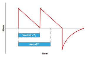 Hình 7.8 Dạng sóng lưu lượng trong kích hoạt kép trong thông khí kiểm soát thể tích. Trong trường hợp này, TI máy thở ngắn hơn TI thần kinh. Trong quá trình TI thần kinh, bệnh nhân co thắt các cơ hít vào, dẫn đến giảm áp lực màng phổi và áp lực đường thở gần. Những nỗ lực hít vào chủ động của bệnh nhân trong quá trình TI máy thở, không kích hoạt máy thở và thay vào đó sẽ làm giảm áp lực đường thở ở chế độ nhắm mục tiêu lưu lượng và tăng lưu lượng trong chế độ nhắm mục tiêu áp lực. Tuy nhiên, những nỗ lực hít vào tích cực trong khi thở ra (sau khi TI máy thở đã hết) có thể kích hoạt máy thở một lần nữa. Trong trường hợp này, một nỗ lực hô hấp của bệnh nhân đã kích hoạt máy thở hai lần.