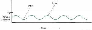 Hình 3.15 Dạng sóng áp lực - thời gian đơn giản cho thấy áp lực đường thở dương liên tục (CPAP). Nhịp thở là tự phát. Áp lực đường thở dương thì hít vào (IPAP) và áp lực đường thở dương thì thở ra (EPAP) có mặt. Áp lực vẫn dương tính và không trở về đường cơ bản bằng không.