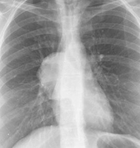 Hình 2.2 Dấu hiệu che phủ rốn phổi. Khối u ở rốn phổi phải chồng lên động mạch phổi chính, không giống rốn phổi bình thường ở bên trái.