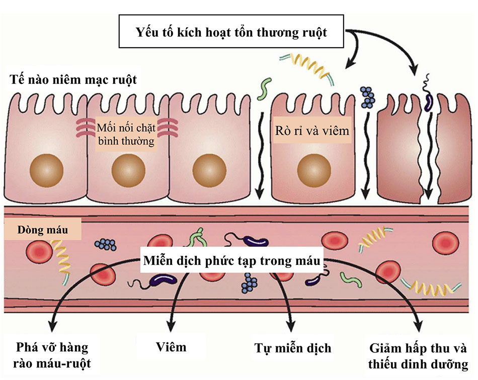 Hội chứng rò rỉ ruột