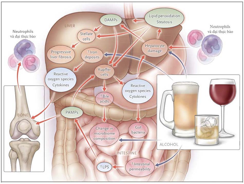 Sơ đồ tổn thương gan do rượu.