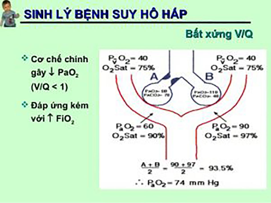 sinh lý bệnh suy hô hấp