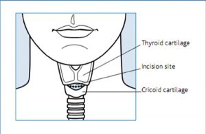 Fig 10 Cricothyroidotomy