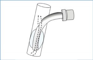 Fig 12 Fenestrated tracheostomy tubes: holes in the tube allows airflow (dashed arrow ) up to the vocal cords