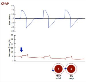 Hình 13 Thông khí áp lực dương liên tục (CPAP)