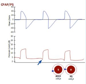 Hình 14 Thông khí áp lực dương liên tục với hỗ trợ áp lực (CPAP/PS)