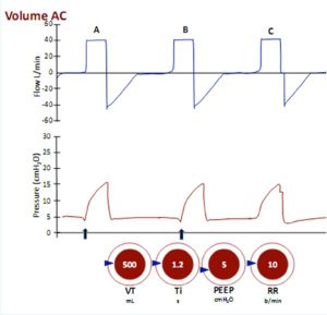 Hình 15 Kiểm soát hỗ trợ thể tích (Volume assist-control)