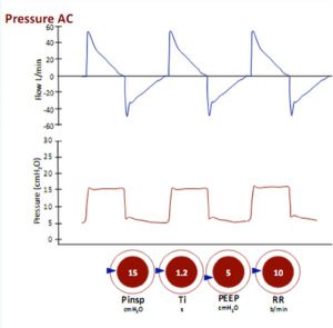 Hình 18 Thông khí kiểm soát áp lực: Áp lực hít vào được cài đặt