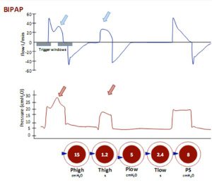 Hình 23 Thông khí áp lực dương hai pha (BIPAP)