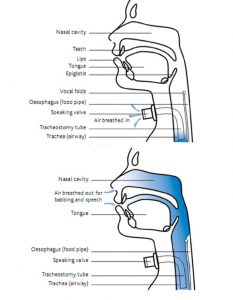 Airflow and phonation in the presence of speaking valve