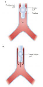 Hình 4.4 Ống nội khí quản trong khí quản. (a) Bóng chèn phồng lên làm kín đường thở trên và cho phép tạo áp lực trong hệ thống hô hấp trong khi hít vào. (b) Một bóng chèn bị thiếu dẫn đến rò rỉ không khí xung quanh bóng chèn và ra khỏi đường thở trên, dẫn đến áp lực đường thở thấp hơn với thông khí được kiểm soát thể tích.