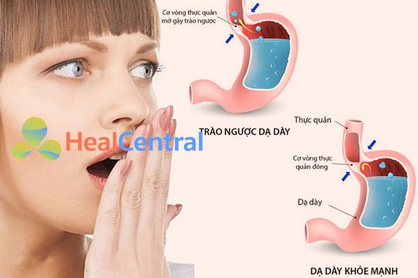 Mẹo điều trị Trào ngược dạ dày thực quản nhanh mà hiệu quả nhất