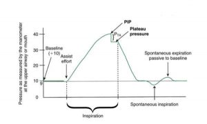 Hình 1.10 Đồ thị của áp lực đường thở xảy ra trong nhịp thở áp lực dương cơ học và nhịp thở tự nhiên.