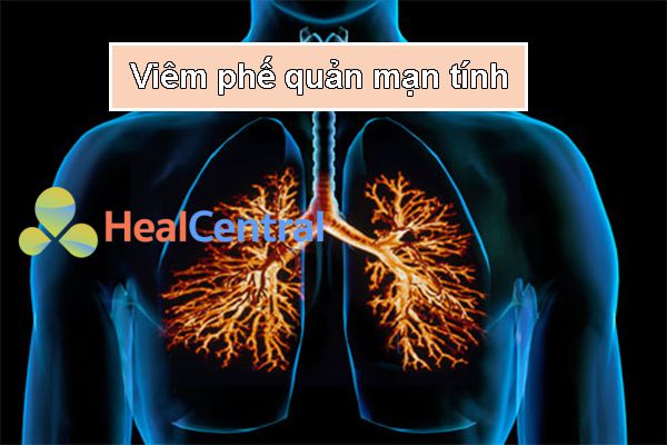 Viêm phế quản mạn tính: dấu hiệu nhận biết, phác đồ điều trị & biến chứng