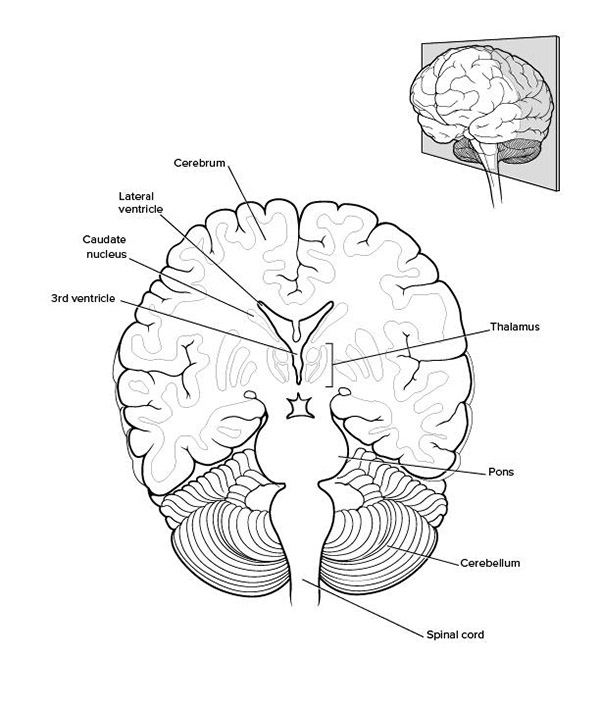 Ảnh. Mặt cắt não nhìn từ phía trước. Cerebrum: đại não, Pons: cầu não, Spinal cord: tủy sống, Cerebellum: tiểu não, Thalamus: vùng đồi thị, Lateral ventricle: não thất bên, Caudate nucleus: nhân đuôi, 3rd ventricle: não thất III.