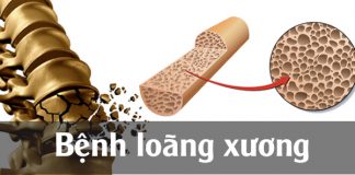 Bệnh loãng xương