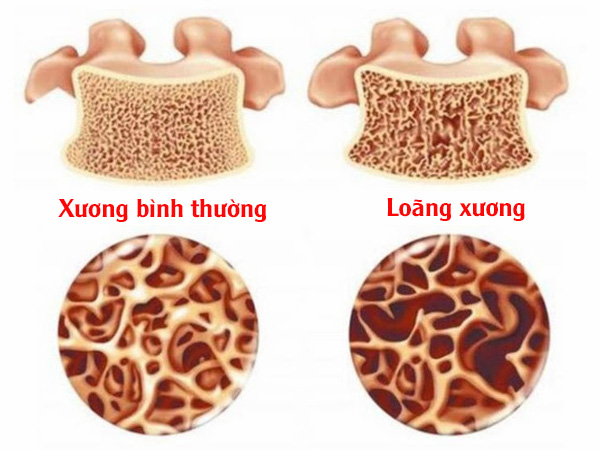 Hình ảnh loãng xương