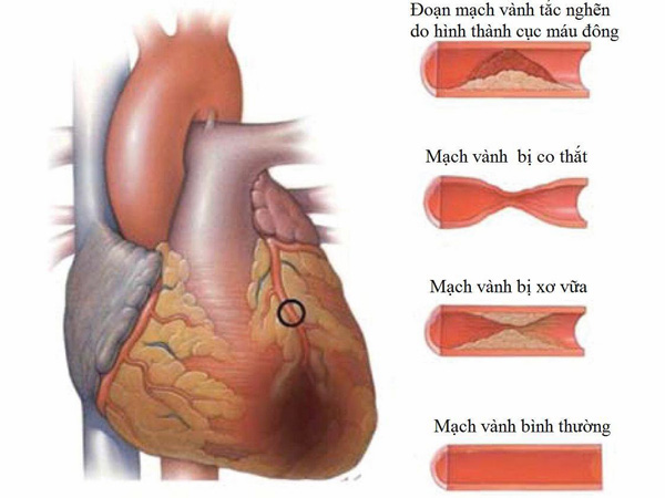 Mảng xơ vữa gây thiếu máu cơ tim