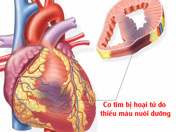 Cơ tim bị hoại tử do thiếu máu nuôi dưỡng