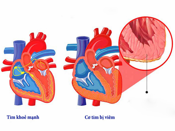 Hình ảnh viêm cơ tim 