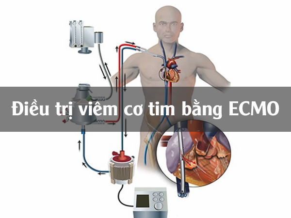 Điều trị viêm cơ tim bằng phương pháp tuần hoàn ngoài cơ thể