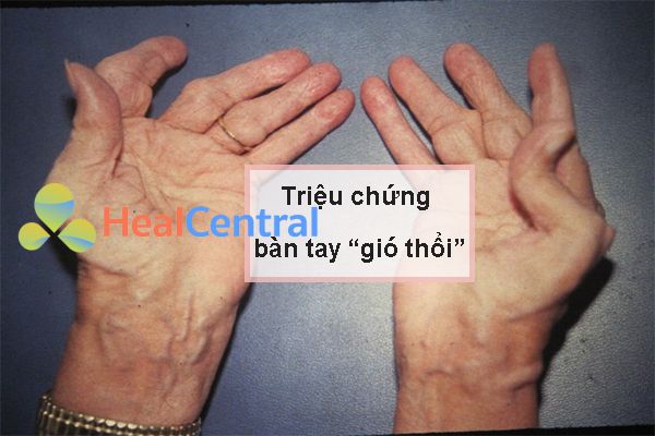 Hình ảnh “bàn tay gió thổi” trong viêm khớp dạng thấp.