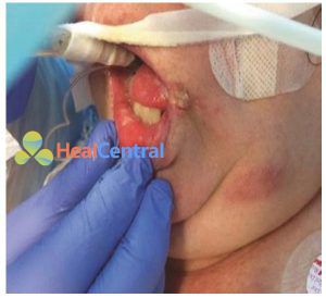 Hình 1.4 Nhiễm herpes miệng (tái hoạt) ở một bệnh nhân đang hồi phục sau viêm phổi do phế cầu khuẩn. Được sự cho phép của Martin W. Dünser, MD.