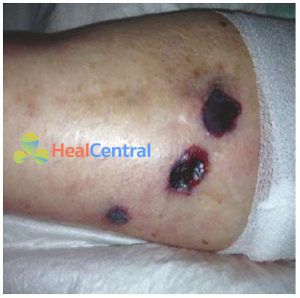 Hình 1.5 Ban đỏ hoại thư - một tổn thương da thường liên quan đến nhiễm Pseudomonas aeruginosa. Được sự cho phép của Martin W. Dünser, MD