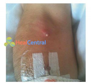 Hình 1.8 Mủ chảy ra từ vị trí chân trước đây của một catheter tĩnh mạch ngoại vi. Được sự cho phép của Sirak Petros, MD.