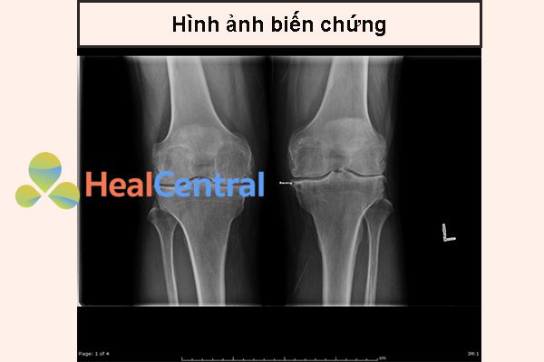 Ảnh. Hình ảnh X-quang hẹp khe khớp gối của bệnh nhân viêm khớp dạng thấp.