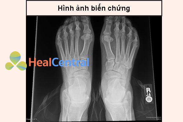Ảnh. Hình ảnh X-quang bàn chân bệnh nhân viêm khớp dạng thấp