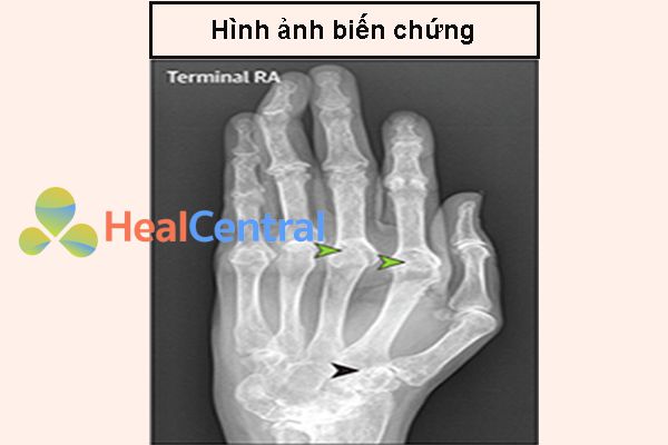 Hình ảnh X-quang bàn tay của bệnh nhân viêm khớp dạng thấp