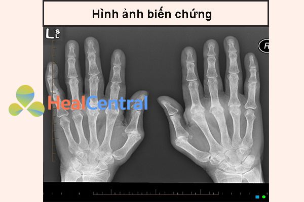 Ảnh. Hình ảnh X-quang bàn tay cho thấy loãng xương, các khớp ngón tay bị di lệch và có dính khớp bàn – ngón tay ở bệnh nhân viêm khớp dạng thấp.