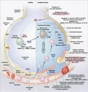 Hình 1. Sinh bệnh học của giai đoạn tiết dịch của ARDS. Đơn vị mao mạch phế nang khỏe mạnh (trái) và pha tiết dịch của ARDS (phải). AECI