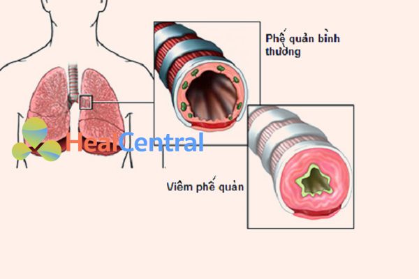 Lưu ý khi sử dụng rau diếp cá chữa viêm phế quản
