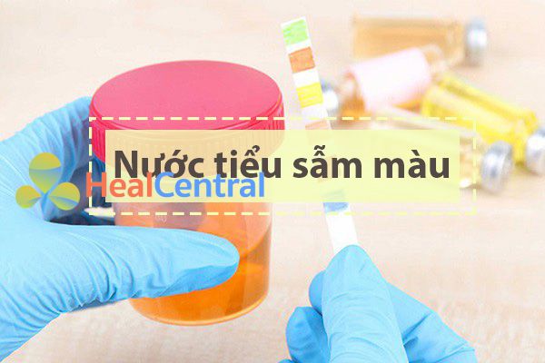 Tác dụng không mong muốn trên tiết niệu của thuốc Flagyl