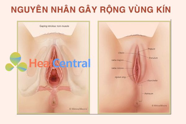 Vùng kín bị rộng do đâu?