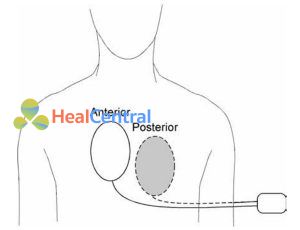 Hình 1.1 Vị trí bản cực cạnh ức phải – cạnh sống trái.